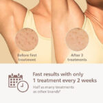 laser hair removal machine price